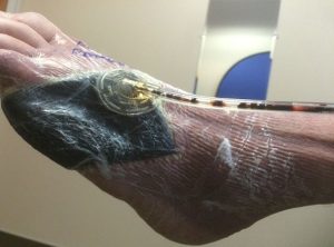 درمان زخم به روش وکیوم تراپی برای نخستین بار در دزفول