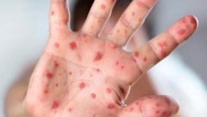 افزایش موارد مشکوک به سرخک در دزفول