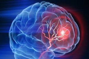 آلزایمر و ارتباط آن با اختلال‌های روان‌پزشکی 